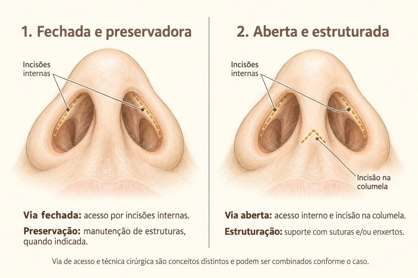 Comparação entre rinoplastia por via fechada preservadora (incisões internas) e via aberta estruturada (incisão na columela)